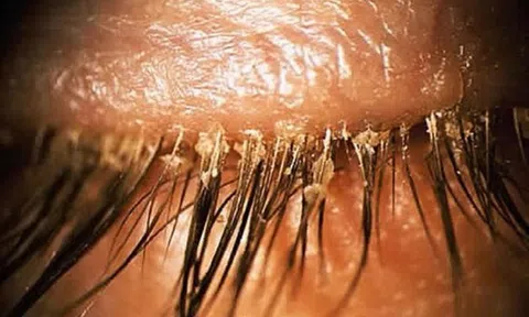 Người phụ nữ 24 tuổi khó chịu ở mí mắt, bác sĩ sốc khi gắp ra thứ "đáng sợ" chi chít trên mi