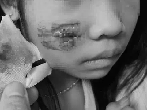 Đang chơi ở sân nhà, bé 8 tuổi bị khỉ tấn công, vết thương phức tạp