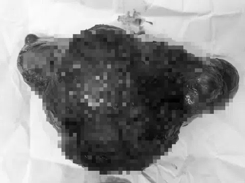 Cụ bà 72 tuổi đau âm ỉ nhiều ngày, bác sĩ sốc khi lấy ra thứ "đáng sợ" bên trong bụng