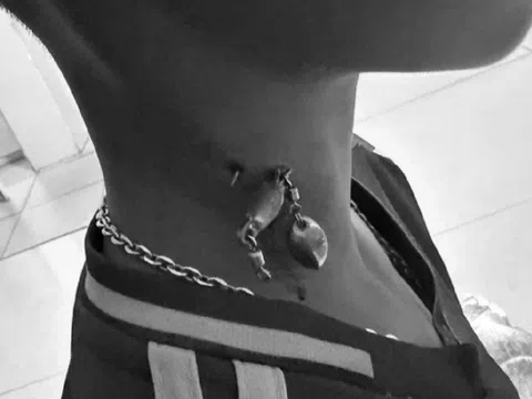 Bé trai 13 tuổi chảy máu nhiều, bác sĩ sốc khi phát hiện bí mật "đáng sợ" ở cổ