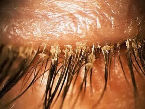 Người phụ nữ 24 tuổi khó chịu ở mí mắt, bác sĩ sốc khi gắp ra thứ "đáng sợ" chi chít trên mi
