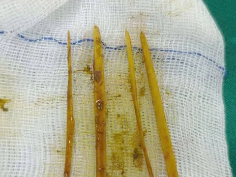 Cô gái 26 tuổi đau bụng dữ dội, bác sĩ “chết lặng” khi phát hiện thứ bên trong